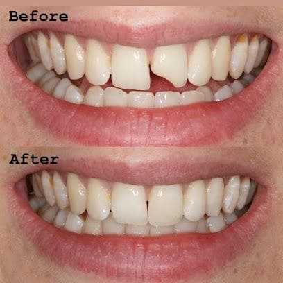 Cavity Treatment — before and after result at Rishita Dental & Aesthetic Clinic
