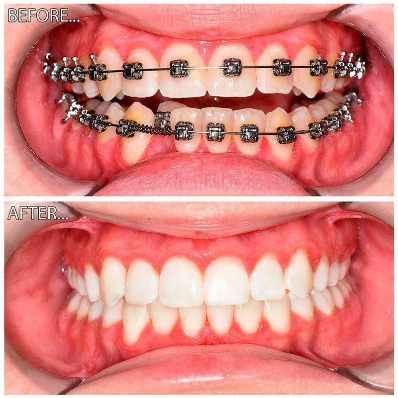 Chipped Tooth Repair — before and after result at Rishita Dental & Aesthetic Clinic
