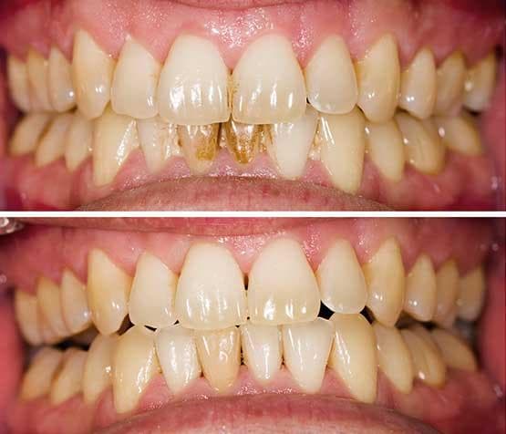 Crown Restoration — before and after result at Rishita Dental & Aesthetic Clinic