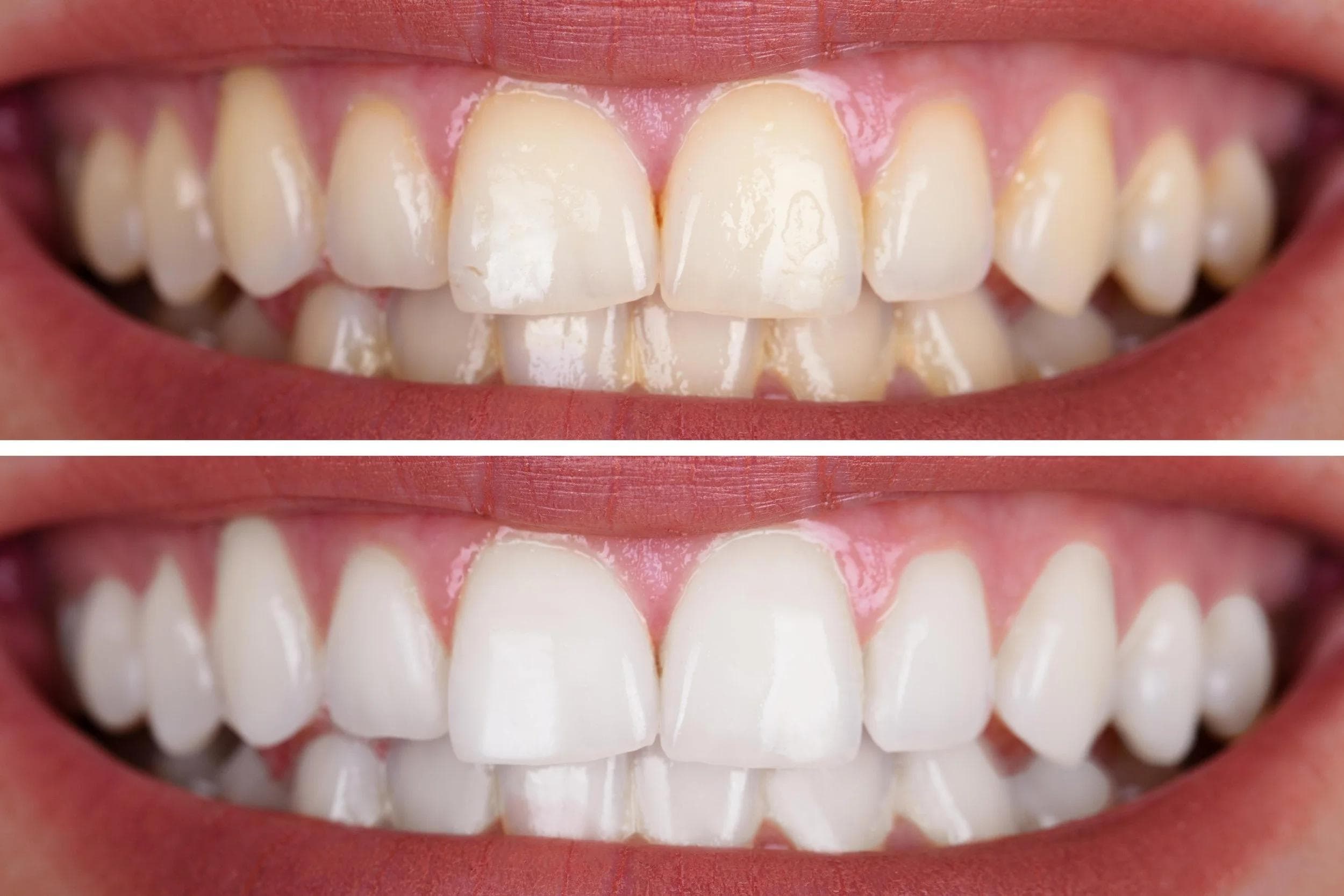 Dental Braces — before and after result at Rishita Dental & Aesthetic Clinic