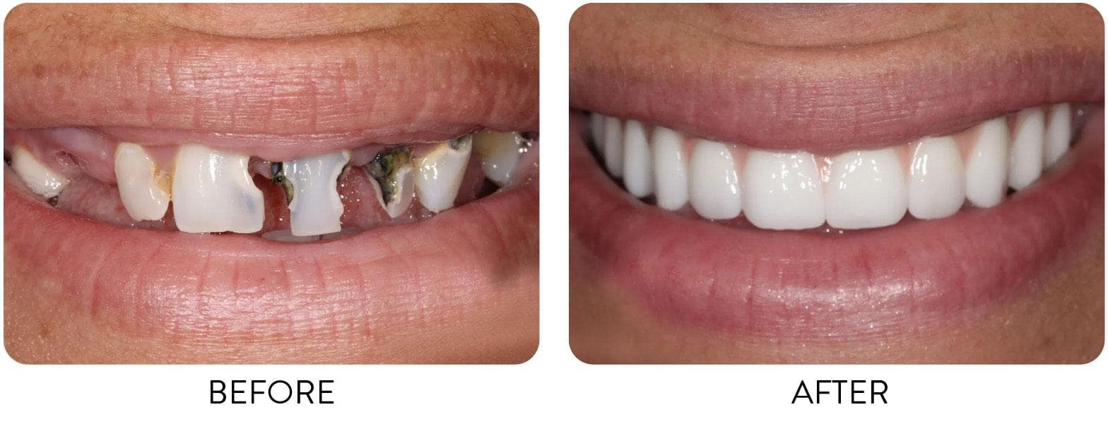 Smile Design — before and after result at Rishita Dental & Aesthetic Clinic