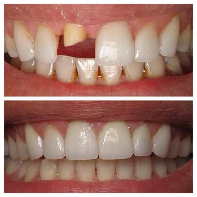 Smile Makeover — before and after result at Rishita Dental & Aesthetic Clinic