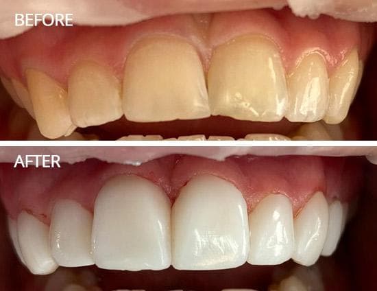 Teeth Whitening — before and after result at Rishita Dental & Aesthetic Clinic